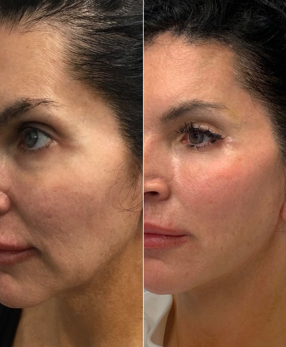 Thread Lift Before And After Photos - Dr Hunt Skin Clinic