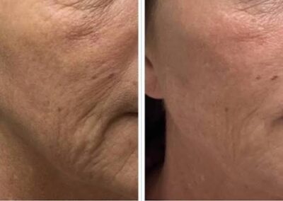 Side-by-side close-up of a persons cheek, showing visible wrinkles and texture on the left, and smoother skin with fewer wrinkles on the right, indicating a before-and-after skincare result.