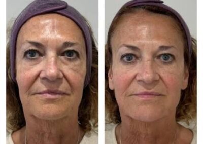 Side-by-side photos of a woman before and after a skincare treatment, showing reduced wrinkles, smoother skin, and a more even complexion. She wears a purple headband in both images.