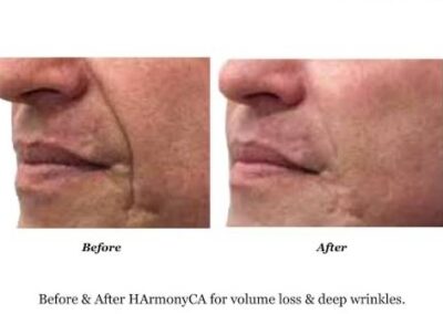 Side-by-side close-up of a persons lower face showing deep wrinkles before treatment (left) and smoother skin after treatment (right). Text: Before & After HArmonyCA for volume loss & deep wrinkles.